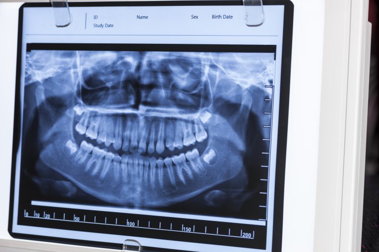 رادیوگرافی پانورکس دندان